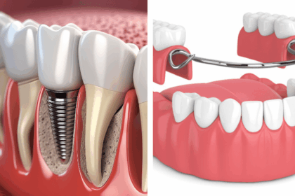 Dental Implants Versus Dentures