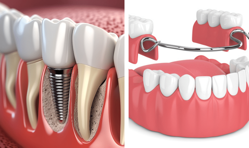 Dental Implants Versus Dentures